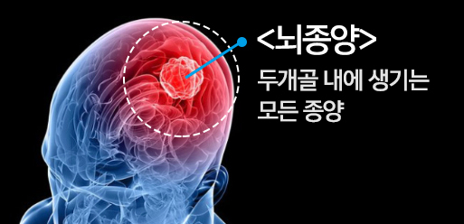 1. 뇌종양(Brain tumor)에 걸린 아빠 살리기(뇌종양 초기증상.진단.입원.수술, 조 티펜스 개구충약 펜벤다졸, 사람 ...