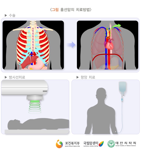 흉선암 정보 (10) : 네이버 블로그
