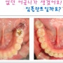 [분당치과추천] 임플란트 없이 사랑니로 어금니 만들기