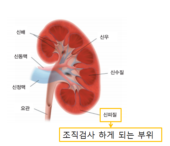 신장(콩팥) 조직 검사란 무엇인지 궁금해요? : 네이버 블로그