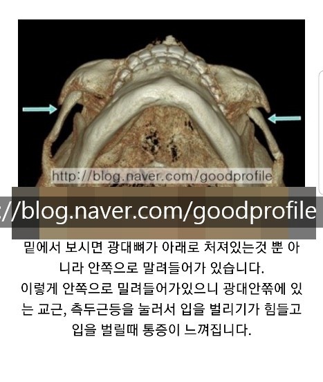 안면윤곽수술 부작용 실제 사례 모음 - 전문의가 직접 설명드립니다 : 네이버 블로그