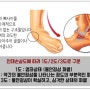 발목 삐끗했을 때 치료법은?