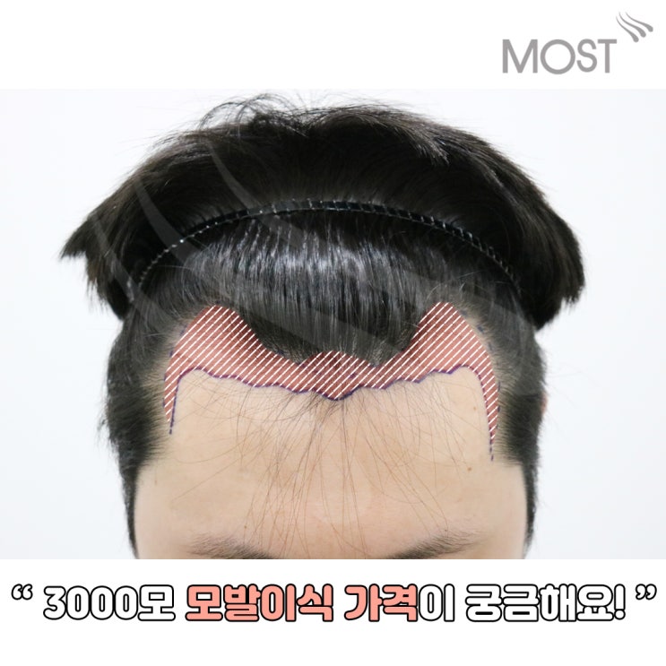 3000모 모발이식가격이 궁금해요! : 네이버 블로그