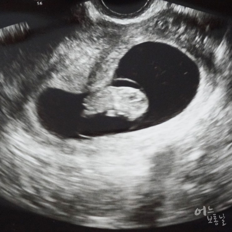 임신 9주차 증상 , 계속되는 입덧 (태아크기 2.5cm) : 네이버 블로그