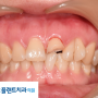 치관 및 치근파절 올세라믹 크라운 수복 사례