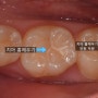 치아 홈메우기/ 보험적용 가능한 충치예방법 뭐가 있을까요?