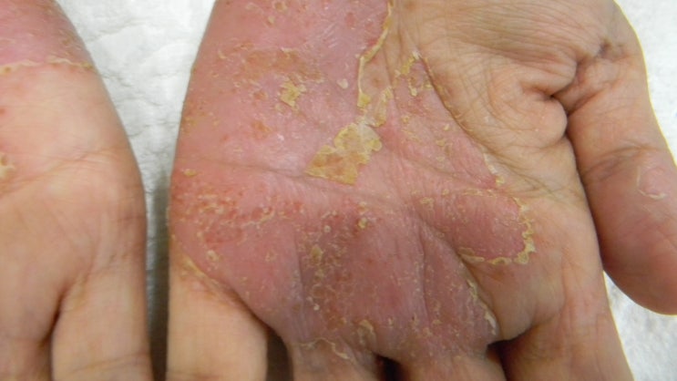 수장족저농포증(손발바닥농포증) 치료법 : 네이버 블로그