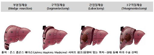 간세포암 정복기! 간암 수술은 어떻게 하는 것일까 : 네이버 블로그