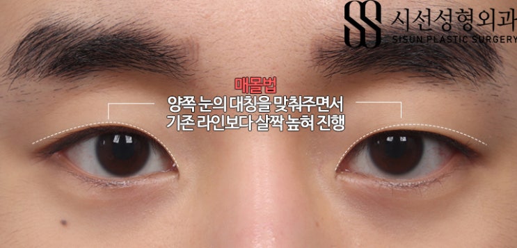 자연스러운 남자 쌍꺼풀 수술 : 5개월차 후기 : 네이버 블로그