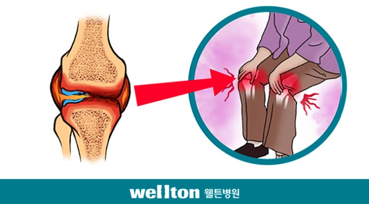 무릎인공관절수술 합병증 , 인공관절수술 부작용 : 네이버 블로그