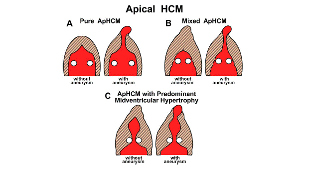 Apical HCM type : 네이버 블로그