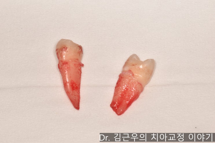 치아 교정 발치 통증 : 네이버 블로그