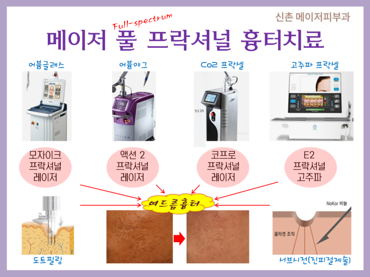 여드름 흉터 레이저 가격 비용 효과 [피부과전문의][신촌메이저피부과] : 네이버 블로그