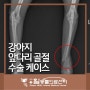 김포동물병원_강아지 앞다리 골절 수술 케이스