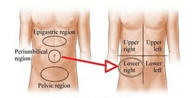Psoas sign , obturator sign, rovsing's sign : 네이버 블로그