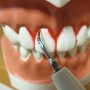 치과위생사 치과기구 제발 올바르게 사용합시다. 스케일러 팁 사용법.