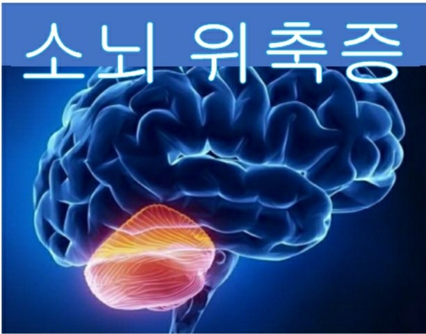 소뇌위축증( 변성증 ) 줄기세포 치료 어떻게 치료할까요??? : 네이버 블로그