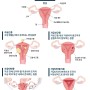 [춘천 자궁질환 한의원] 자궁근종, 자궁선근증, 자궁내막증, 자궁내막증식증... 자궁질환이 이렇게 다양한가요?