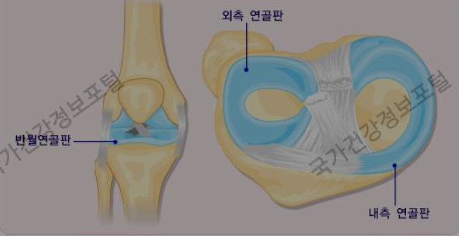 무릎통증, 반월상 연골판 손상, 인대 손상, 연골 손상, 무릎관절주위골절 증상 및 치료 : 네이버 블로그