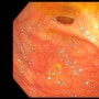 [삼계동 으뜸내과] 대장에서 발견된 MALT lymphoma, 림프종