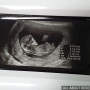 태아 목투명대 검사기준과 임신 3개월 증상