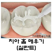 용인처인구치과/가지런한용인치과: 치아홈메우기