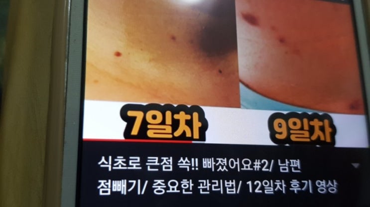 식초를 이용한 기미, 쥐젓, 점 빼기 : 네이버 블로그