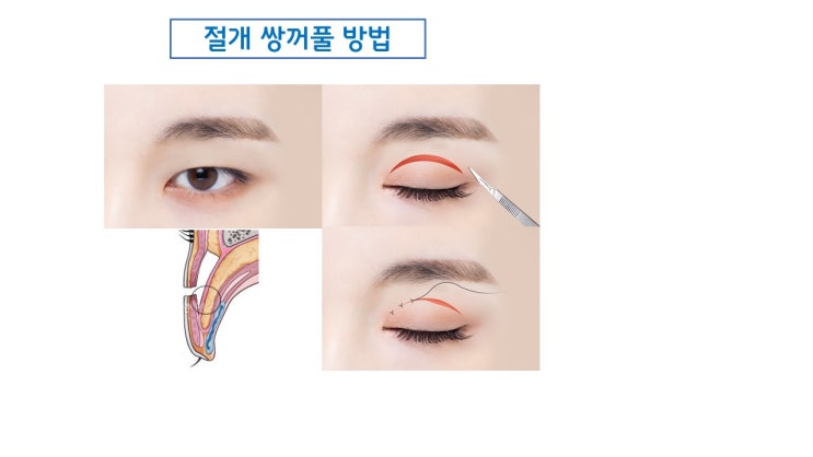 쌍수 절개 풀림은 절대로 일어날 수 없는 쌍수 부작용? : 네이버 블로그