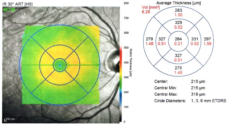 [영상진단]OCT(Optical Coherence Tomography) : 네이버 블로그