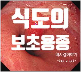 식도에 보초용종이 있다는데 그것도 용종인가요? Sentinel polyp : 네이버 블로그