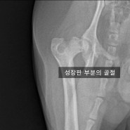 대퇴골두 성장판 골절 수술