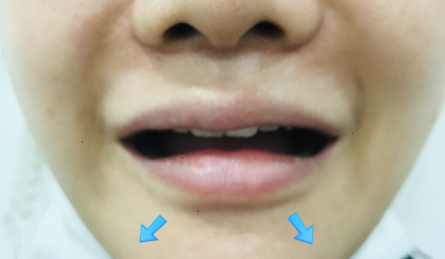 자갈턱 보톡스 부작용 - 합죽이 입 : 네이버 블로그