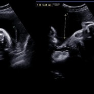 [슈니+희빵] 2세를 만나다 - 36주 0일 / 막달검사/ 출산전 마지막 검사 / W여성병원 / 이란성쌍둥이 / 이란성쌍둥이 몸무게