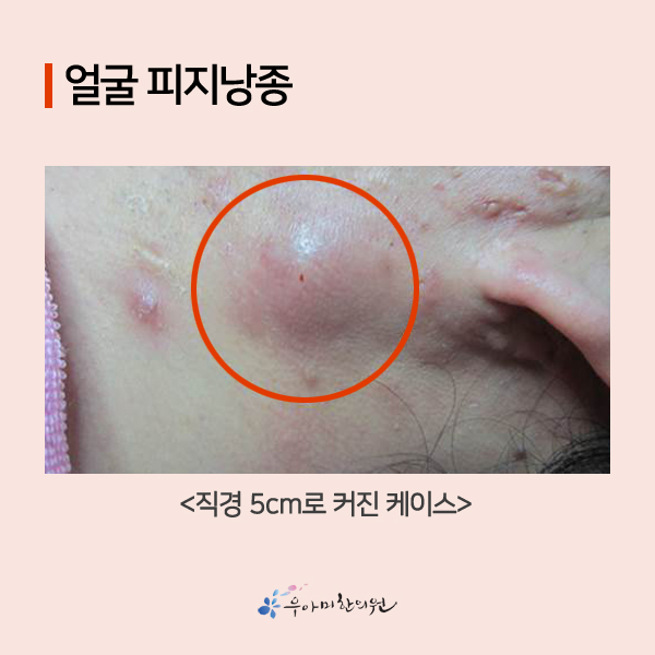 얼굴 종기 딱딱해져간다면? : 네이버 블로그