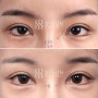 짝눈 수술, 짝눈교정 : 윗트임, 밑트임 7개월