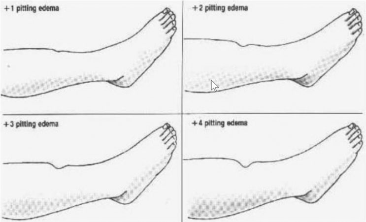 Pitting Edema pitting-edema
