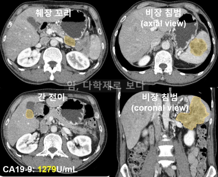 췌장암에 효과 좋고 부작용은 적은 2차 항암제가 있나요? - 오니바이드, 췌장암 환자에서 새로운 희망 : 네이버 블로그