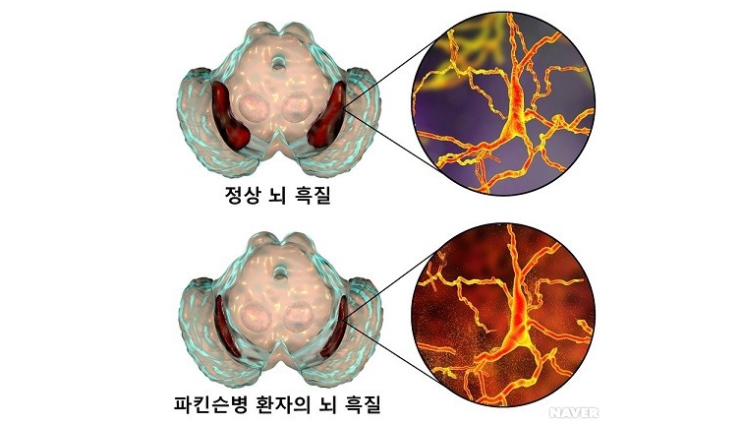 파킨슨병 [ Parkinson's disease ] - 도파민 신경세포의 소실로 인해 발생하는 신경계의 만성 진행성 퇴행성 질환 ...