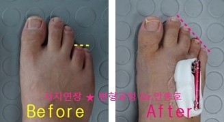 발가락 단지증 : 네이버 블로그