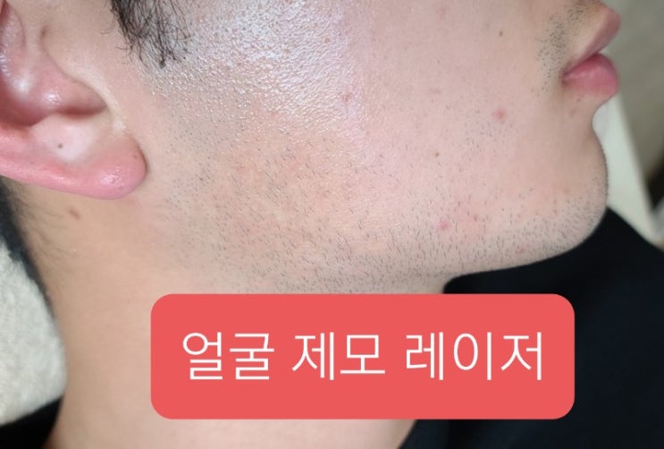 제모-얼굴,겨드랑이,다리, 팔 : 네이버 블로그