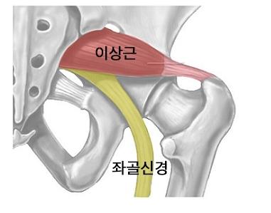울산 박철 정형외과 - 좌골신경통의 원인과 좌골신경통스트레칭법! : 네이버 블로그