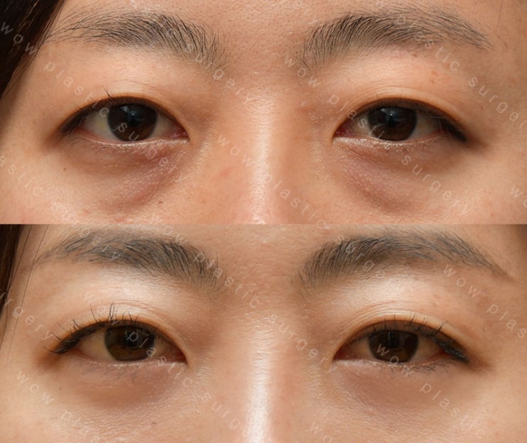 눈밑지방재배치 전후사진 : 네이버 블로그