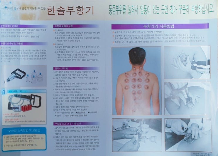 한솔부항기로 부항 사용방법,부항 효과,부항 시간, 주의할점 알아보기! : 네이버 블로그