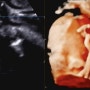 임신25주~28주 입체초음파, 임산부 염색, 엘라 손목보호대, 백일해주사