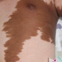 유아거대(초대형) 밀크커피반점 저출력타겟포커싱 치료 사례