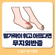 [강북21세기병원 정형외과] 휘고 아픈 발가락! 무지외반증이란?