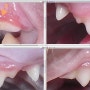치은증식과 치아흡수병변 의 구분[고양이치은염]