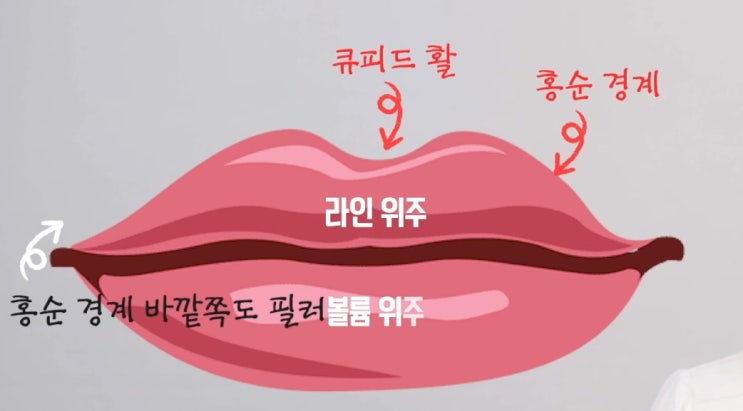 입술필러 입꼬리필러 입꼬리보톡스 예쁘게 시술하는 비법 : 네이버 블로그
