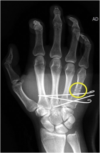 Closed Reduction Percutaneous Pinning : 네이버 블로그