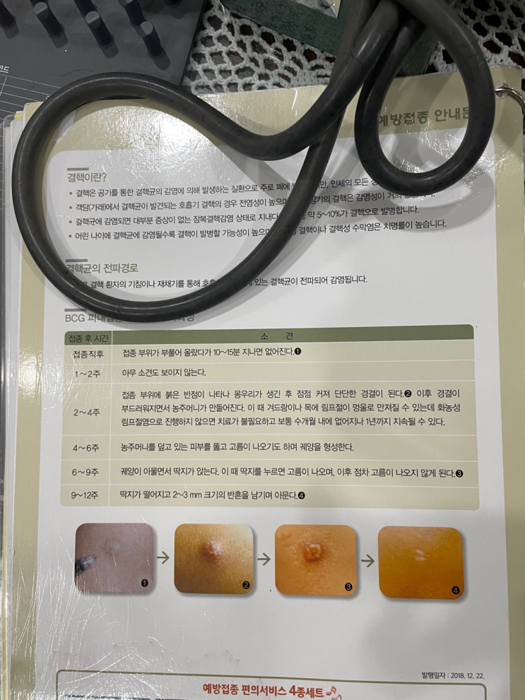 [육아일기] 신생아 BCG 접종 시기와 피내용 예약 고름 및 흉터 : 네이버 블로그
